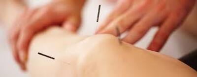 dryneedling chirocure clinic stkilda